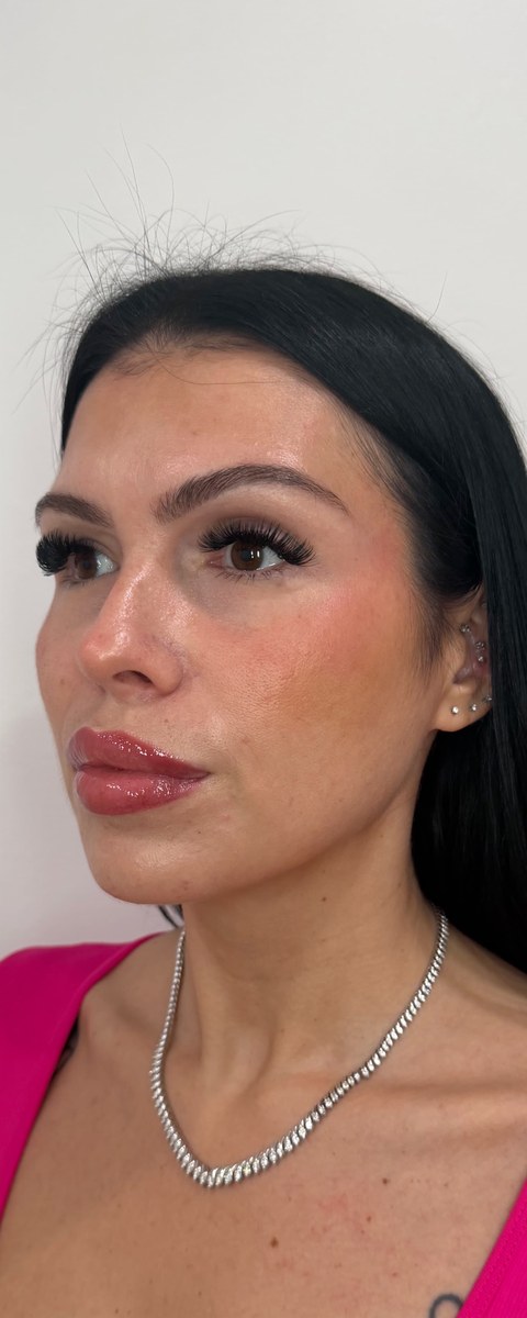 Facial balancing after, the same patient showing refined proportion, restored mid-face structure, and natural lip definition after a multi-treatment facial balancing plan by Natasha Wilkes, NP.