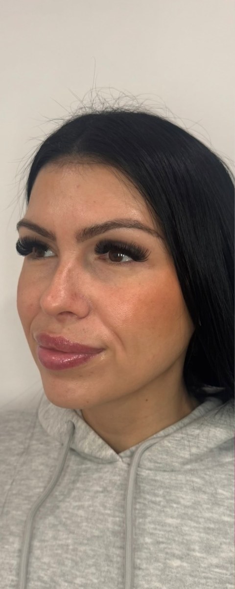 Facial balancing before, three-quarter view of a female patient at The Aesthetic Ranch in Fort Lauderdale showing initial facial proportion prior to a combination injectable plan.