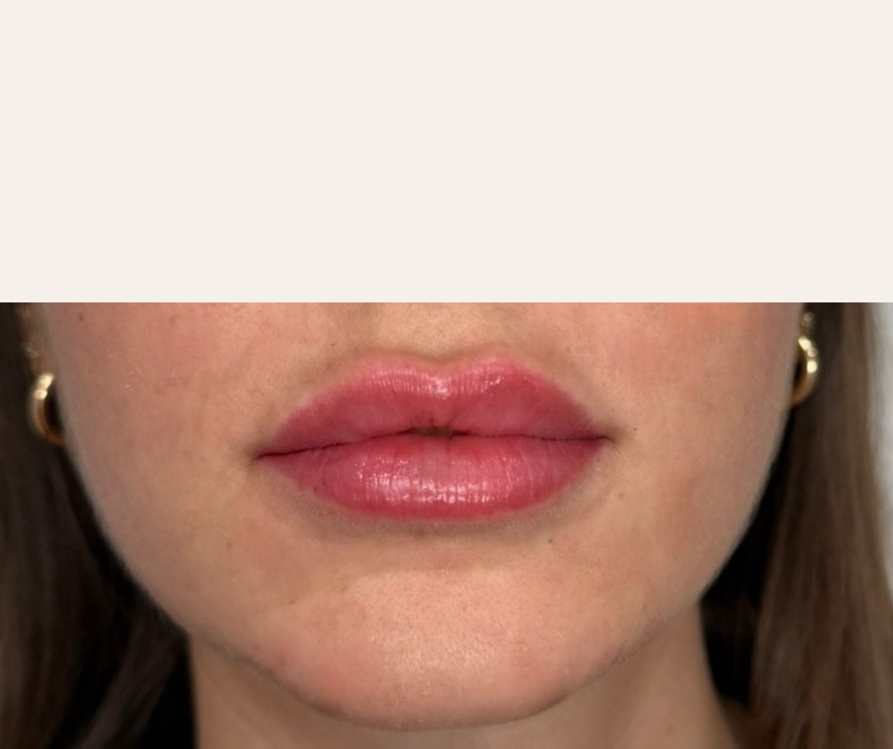 Lip filler after, defined cupid's bow and balanced upper and lower lip volume by Natasha Wilkes, NP.