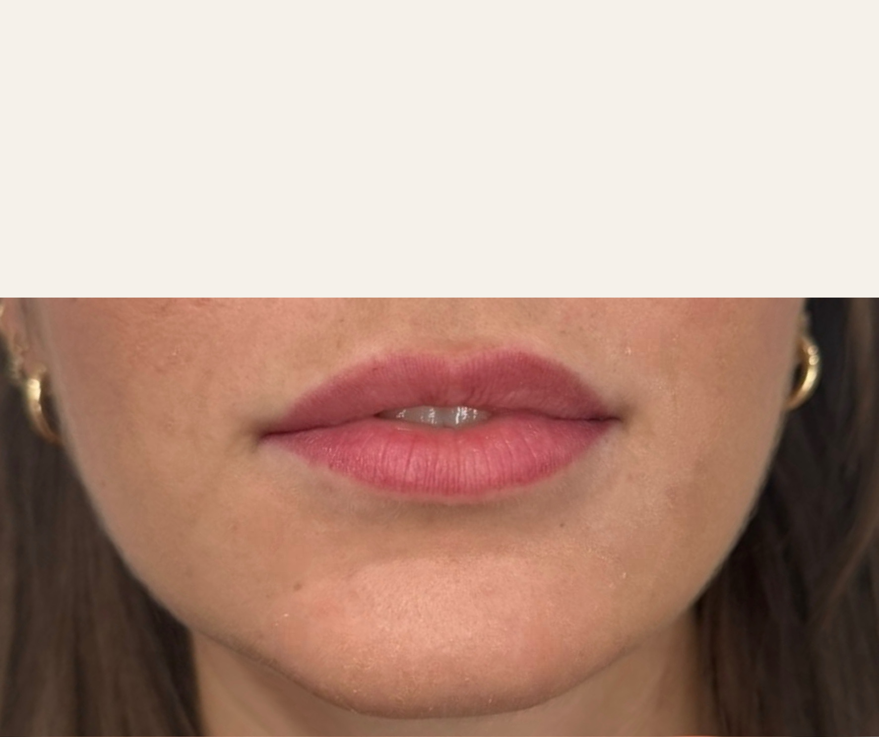 Lip filler before, natural lip shape with minimal vermillion border definition.
