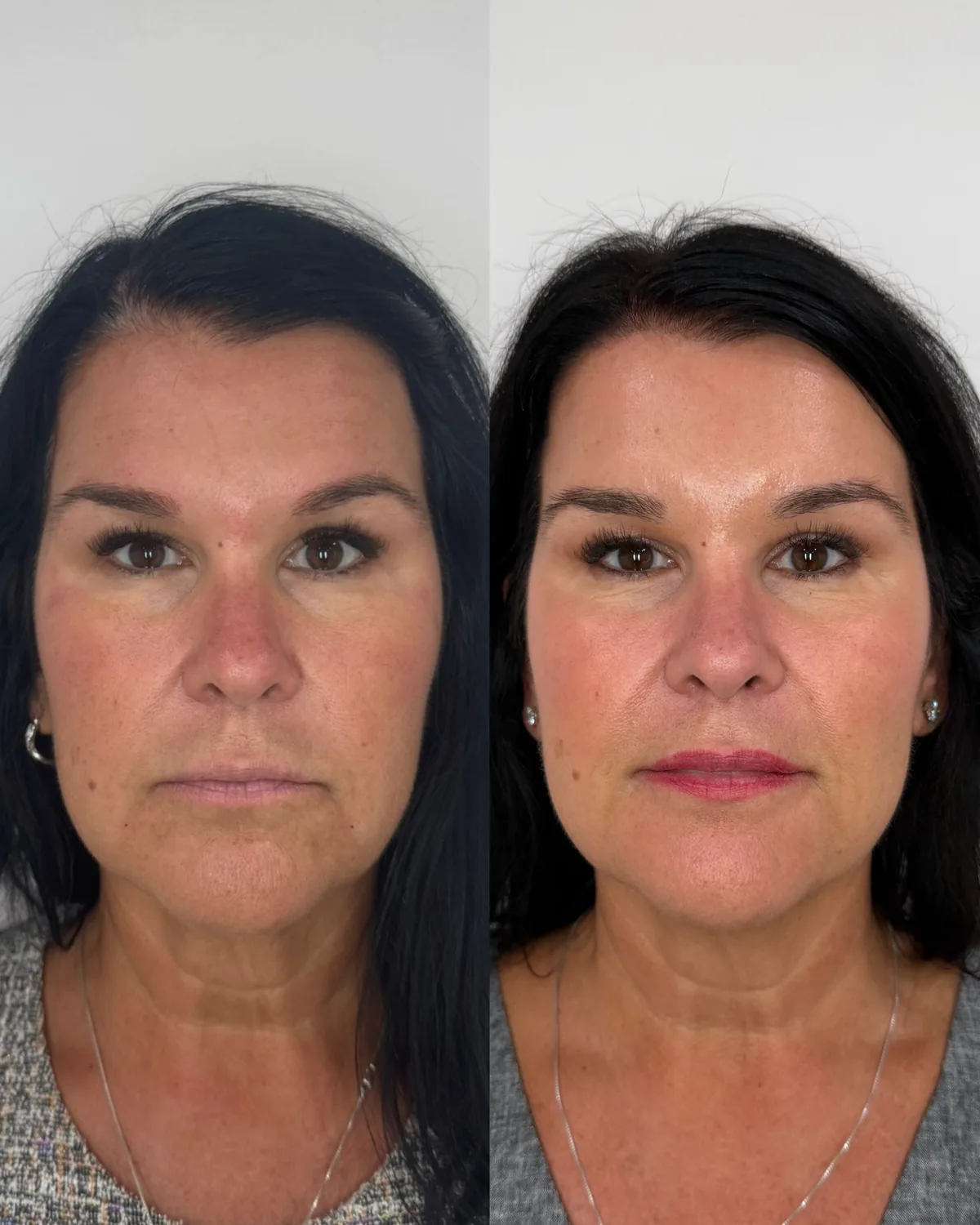 Sculptra and lip filler before and after at The Aesthetic Ranch in Fort Lauderdale, FL, front view of a female patient showing restored mid-face volume, smoother, more even skin, and naturally fuller, more defined lips after a Sculptra series with lip filler by Natasha Wilkes, NP.