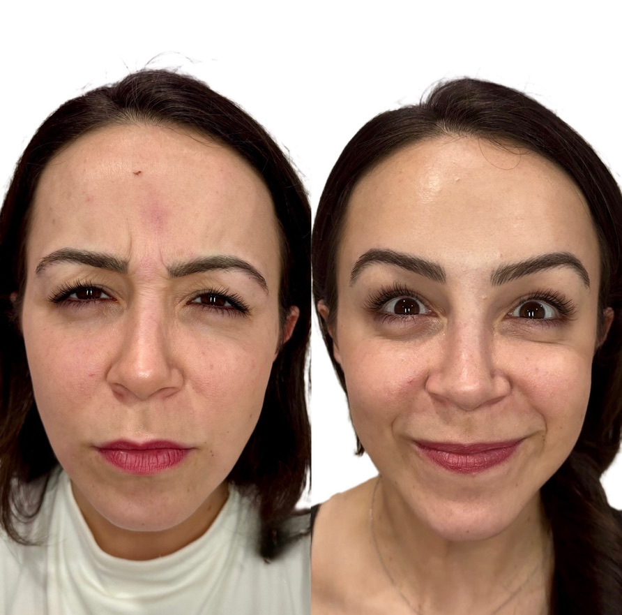 Side-by-side Botox before and after at The Aesthetic Ranch in Fort Lauderdale, smoother forehead, lifted brow, and a refreshed, rested appearance two weeks post-treatment.