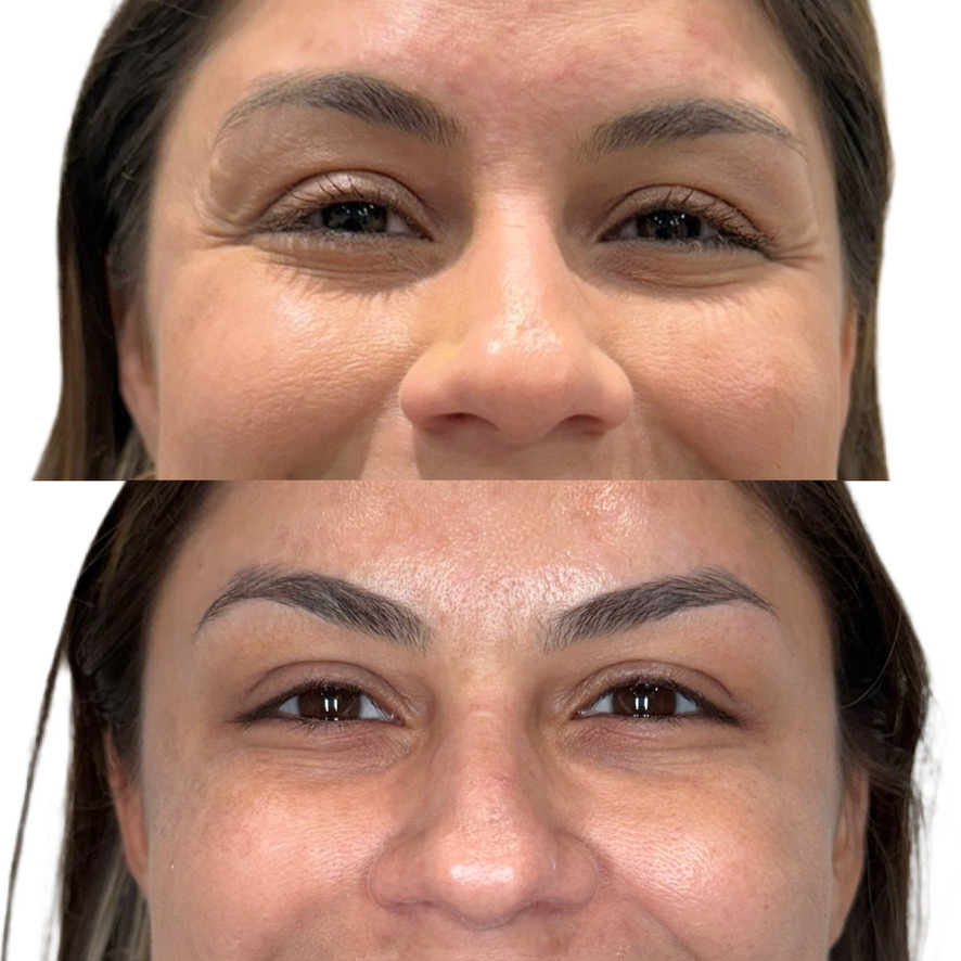 Natasha Wilkes, NP, performing a Botox injection on a patient at The Aesthetic Ranch in downtown Fort Lauderdale, Florida.