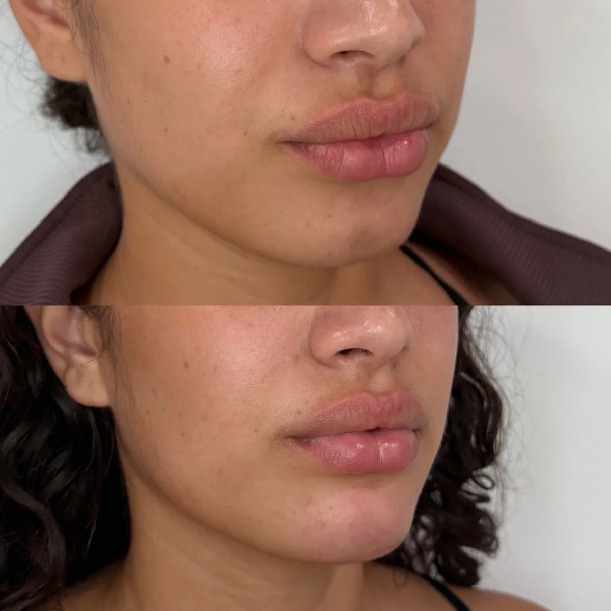 Chin and jawline filler before and after at The Aesthetic Ranch in Fort Lauderdale, FL, three-quarter view showing improved chin projection and a more defined, balanced lower-face profile after a conservative HA filler treatment by Natasha Wilkes, NP.