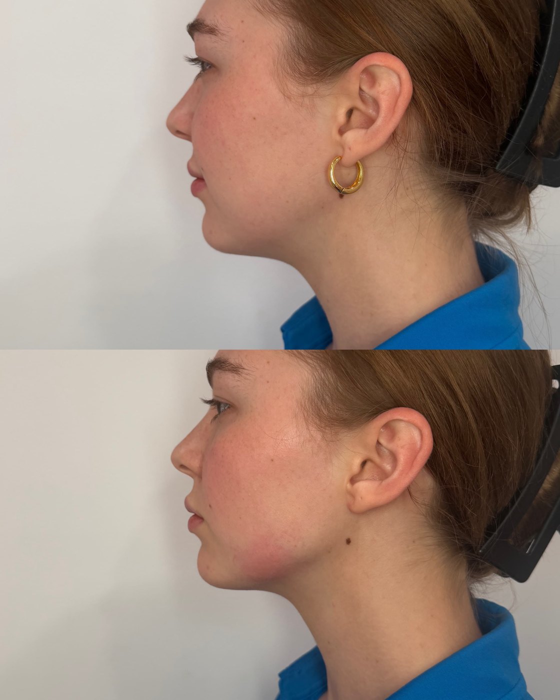 Side profile dermal filler before and after at The Aesthetic Ranch in Fort Lauderdale, refined chin projection and a more defined jawline.