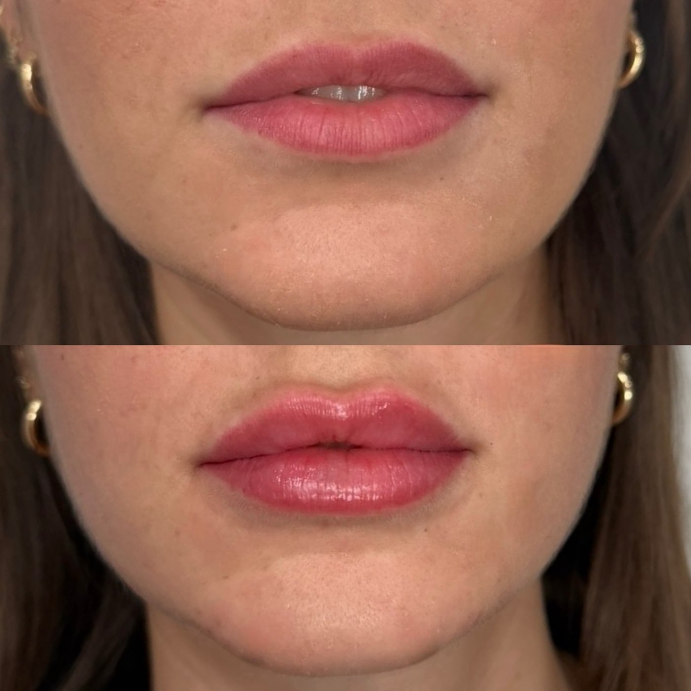 Lip filler before and after at The Aesthetic Ranch in Fort Lauderdale, balanced upper and lower lip with refined definition.