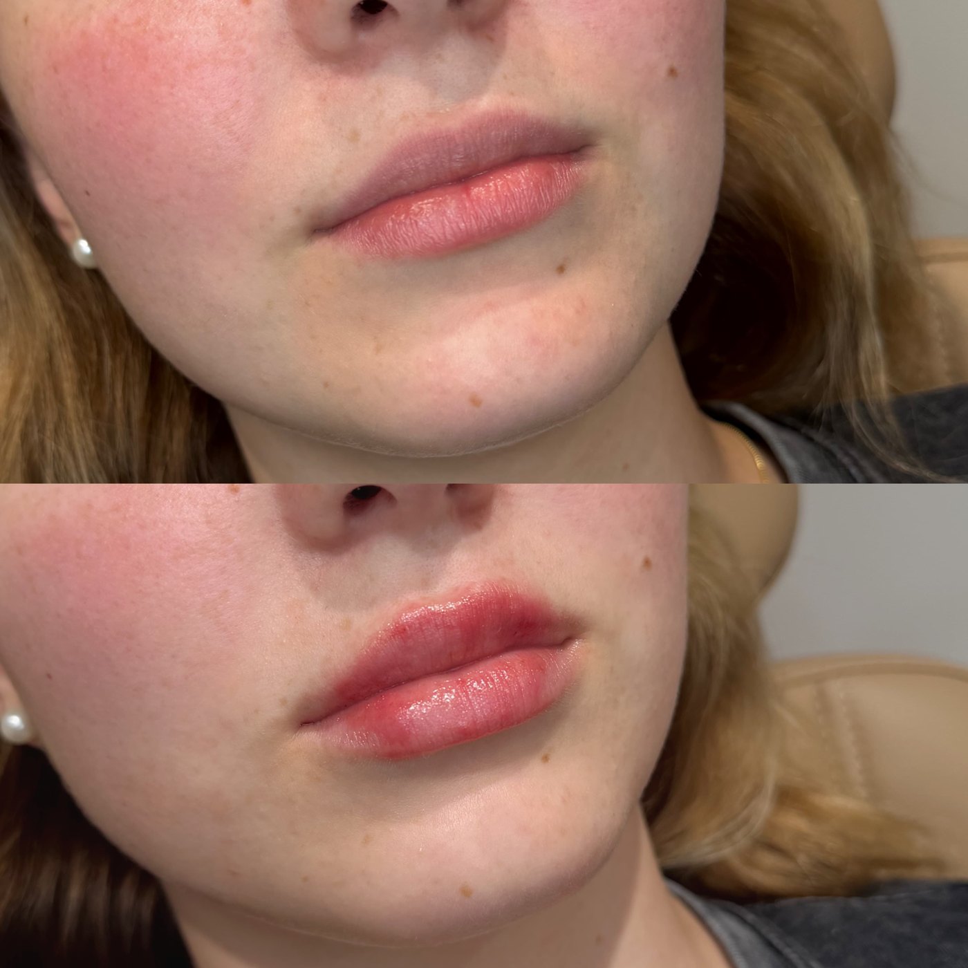 Lip filler before and after, three-quarter view, at The Aesthetic Ranch in Fort Lauderdale, restored hydration and natural shape.