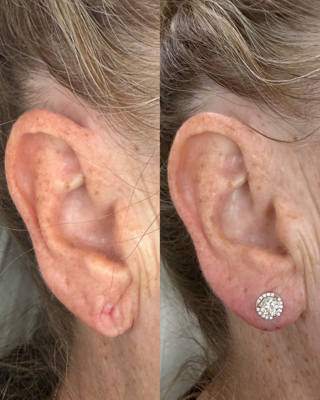 Earlobe filler before and after at The Aesthetic Ranch in Fort Lauderdale, FL, a single conservative HA filler correction restored earlobe volume and shape so the lobe holds a stud earring comfortably, performed by Natasha Wilkes, NP.