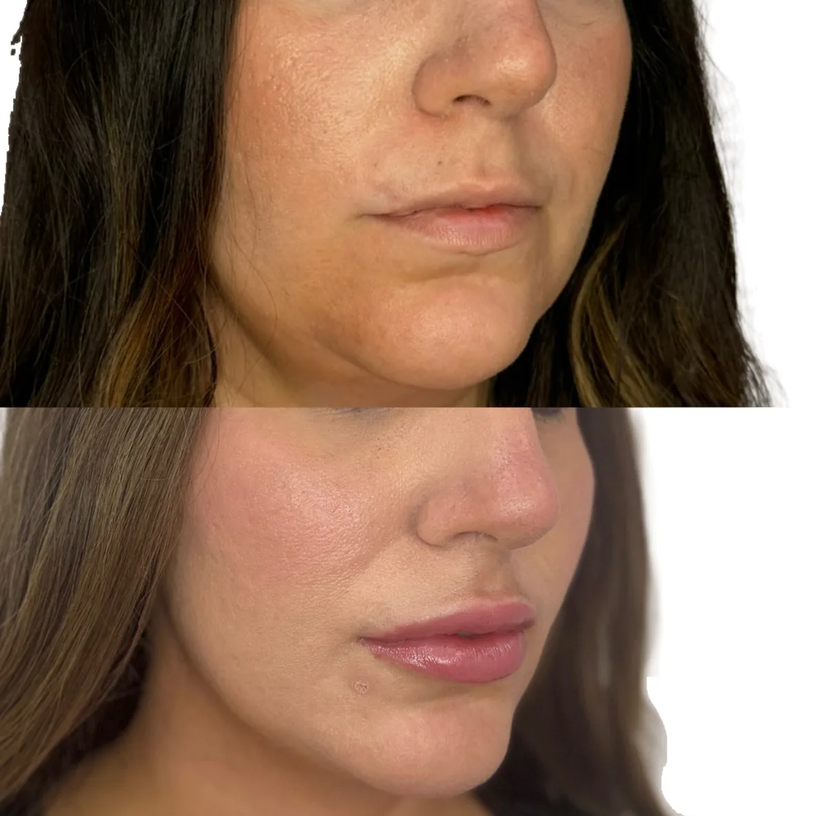 Lip filler and lower-face balancing before and after at The Aesthetic Ranch in Fort Lauderdale, FL, three-quarter view showing fuller, more defined lips and a smoother, more balanced jawline and chin after a considered filler plan by Natasha Wilkes, NP.