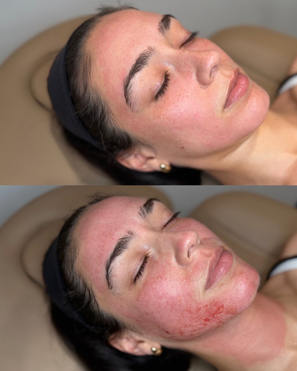 Immediately-after microneedling at The Aesthetic Ranch in Fort Lauderdale, FL, vertically stacked composite showing the controlled pinpoint dermal response across the cheek and jawline that marks the start of the body's collagen healing cascade, performed by Natasha Wilkes, NP.