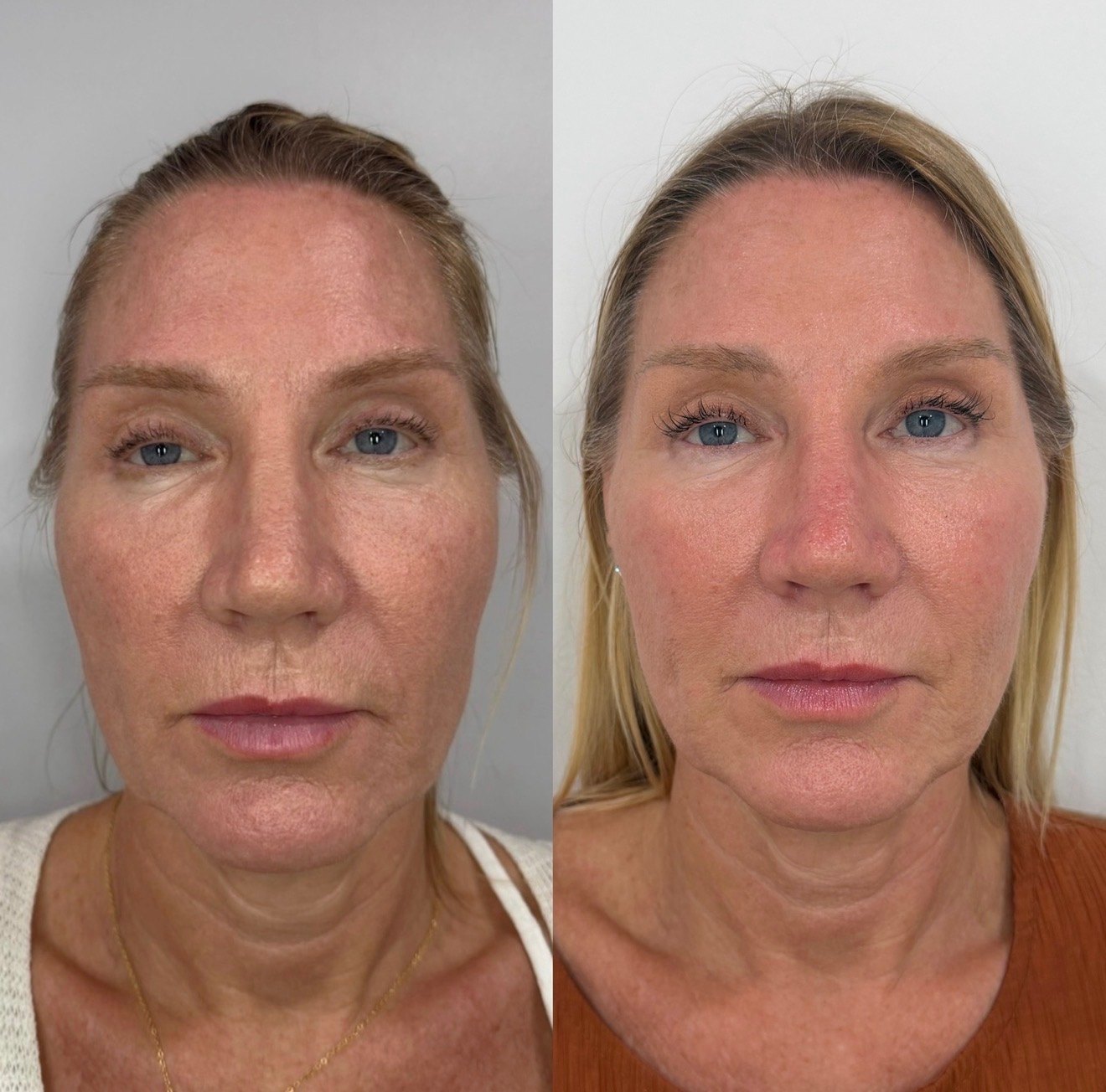 Side-by-side before and after at The Aesthetic Ranch in Fort Lauderdale, FL, showing refined skin texture, more even tone, brighter under-eye area, and improved overall skin quality after a PRP and PRF bio-regenerative treatment series with Natasha Wilkes, NP.