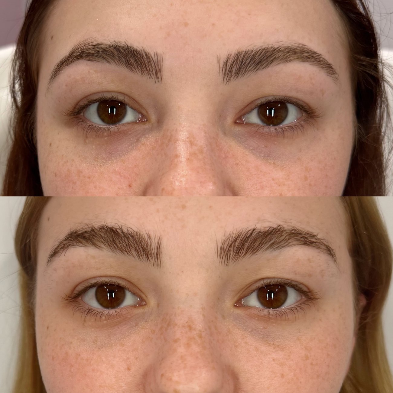 Under-eye PRF EZ Gel before and after at The Aesthetic Ranch in Fort Lauderdale, FL, reduced under-eye shadowing and a smoother, more rested tear-trough surface after an autologous PRF treatment by Natasha Wilkes, NP.