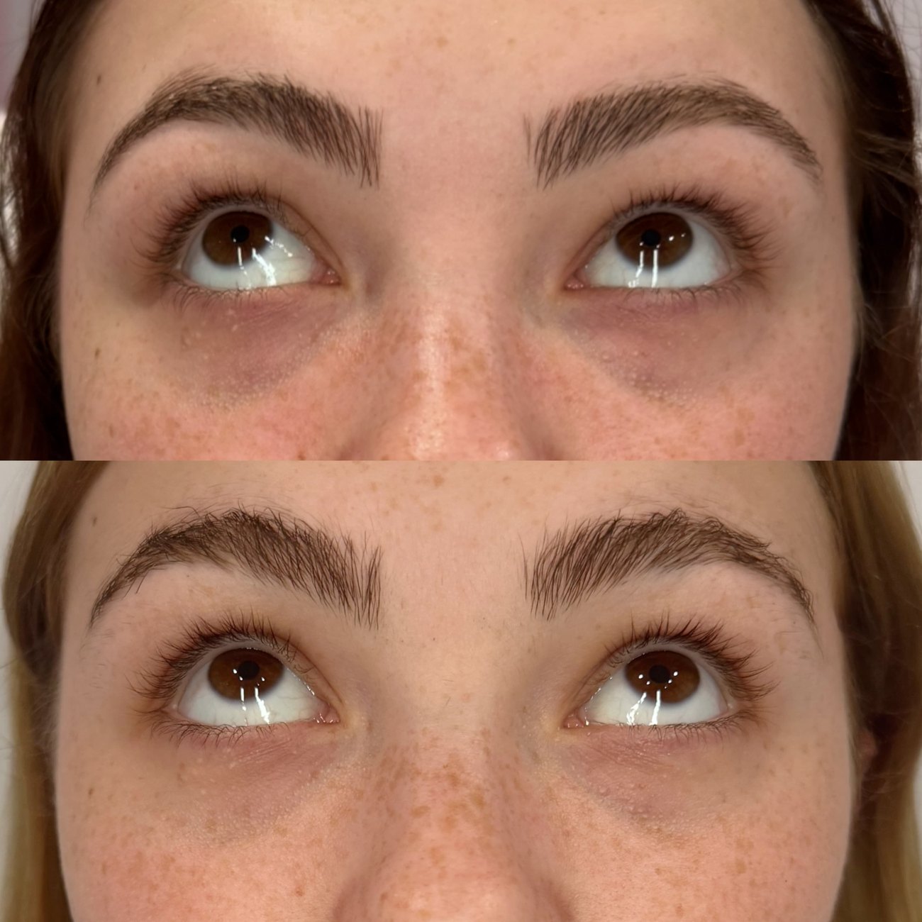 Under-eye PRF before and after at The Aesthetic Ranch in Fort Lauderdale, FL, a second patient showing brighter under-eye area and refined tear-trough texture after a regenerative platelet-rich fibrin series by Natasha Wilkes, NP.