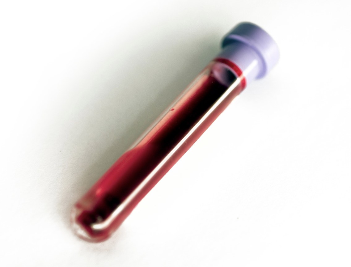 Collection vial of whole blood drawn from a patient at The Aesthetic Ranch in Fort Lauderdale, the first step in preparing platelet-rich plasma (PRP) and platelet-rich fibrin (PRF) bio-regenerative treatments.