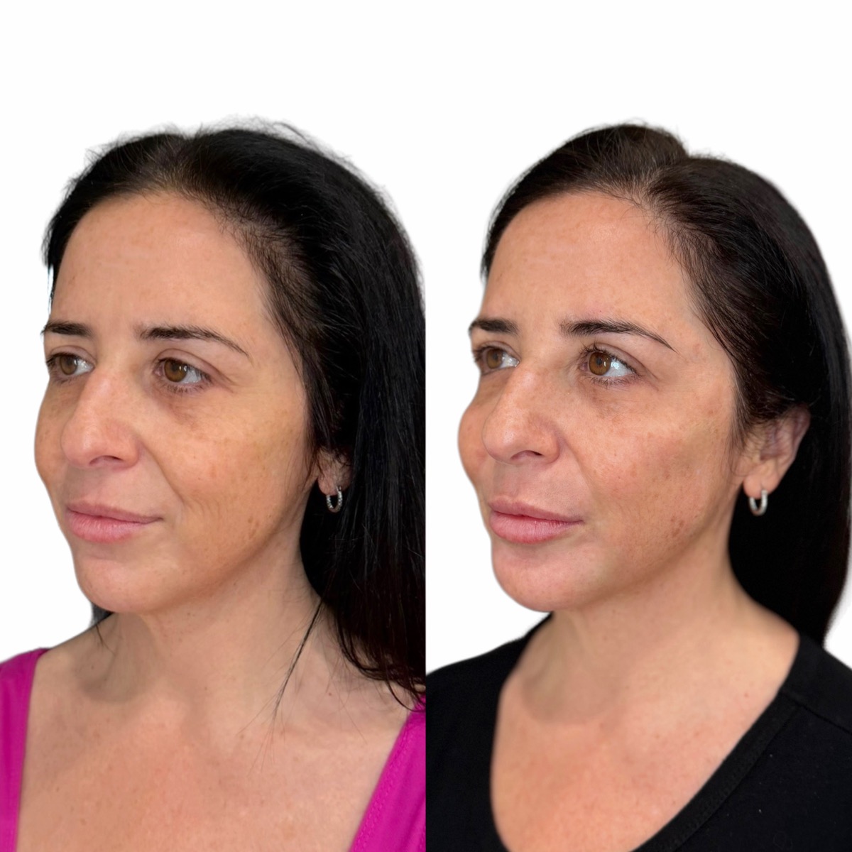 Radiesse before and after at The Aesthetic Ranch in Fort Lauderdale, three-quarter view of a female patient showing improved mid-face and cheek volume, smoother lower face, and refreshed skin quality after a Radiesse treatment performed by Natasha Wilkes, NP.