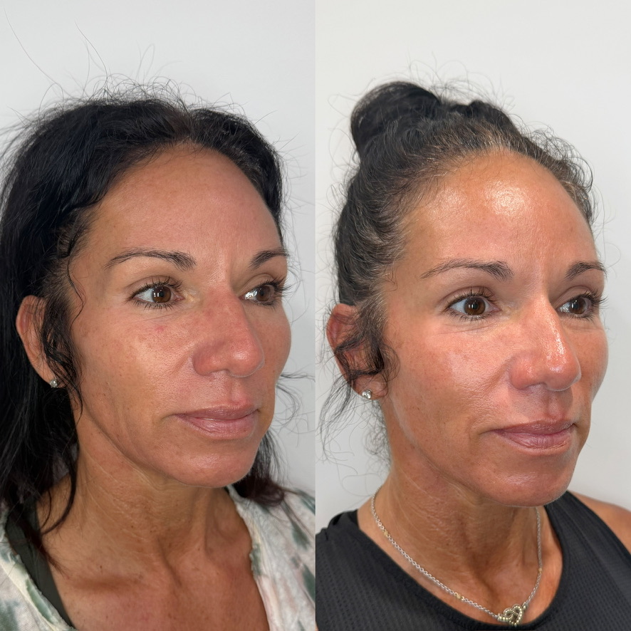 Sculptra before and after at The Aesthetic Ranch in Fort Lauderdale, three-quarter view of a female patient showing improved mid-face volume, lifted cheek contour, and refined overall skin quality after a Sculptra Aesthetic treatment series performed by Natasha Wilkes, NP.