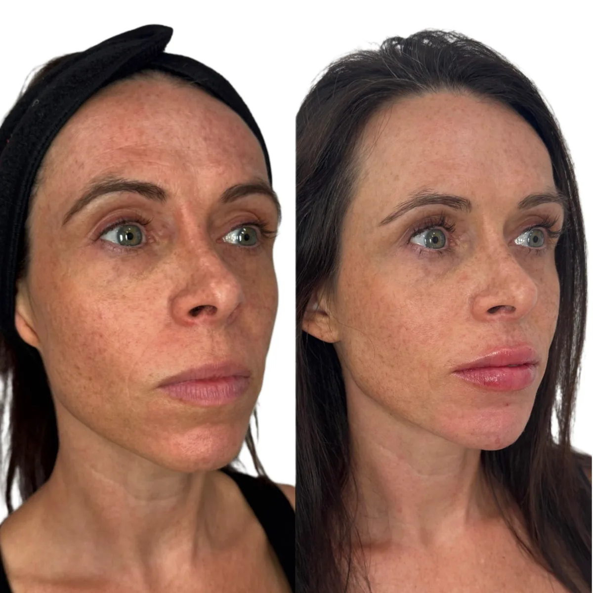 Sculptra before and after at The Aesthetic Ranch in Fort Lauderdale, three-quarter view of a female patient showing clearer, more even skin and restored mid-face volume after a Sculptra Aesthetic collagen-stimulating series performed by Natasha Wilkes, NP.